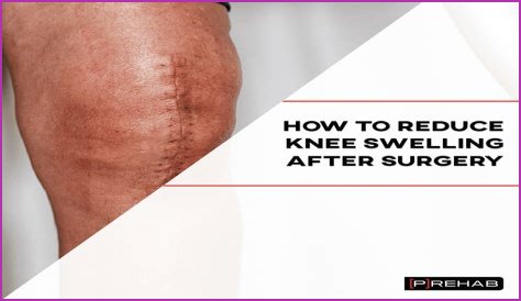 Kevin Nash Shows Off Body Transformation After Knee Replacement